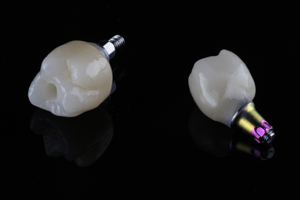 Can All My Teeth Be Replaced With Implants?
