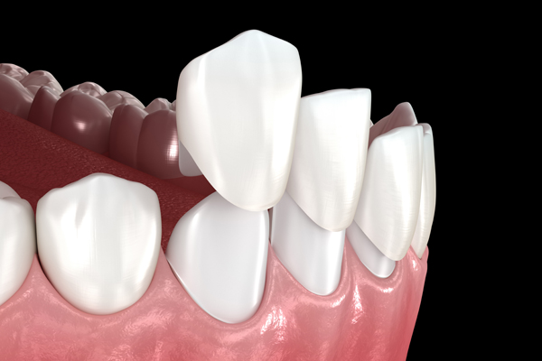Pros And Cons Of Dental Veneers