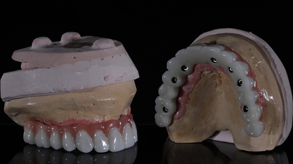 What Happens If I Need My Implant Supported Dentures Repaired?