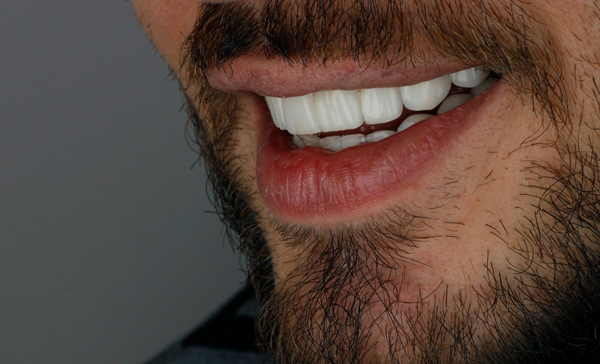 Smile Makeover Options Before The Big Day