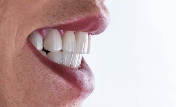 Invisalign for an Overbite  Aligners for Overbite in Rockville Centre, NY